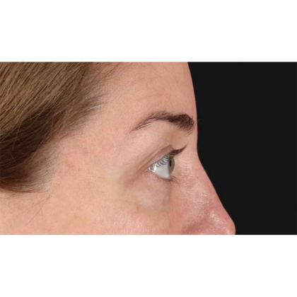 Blepharoplasty (Eyelid Surgery) Before & After Patient #10584