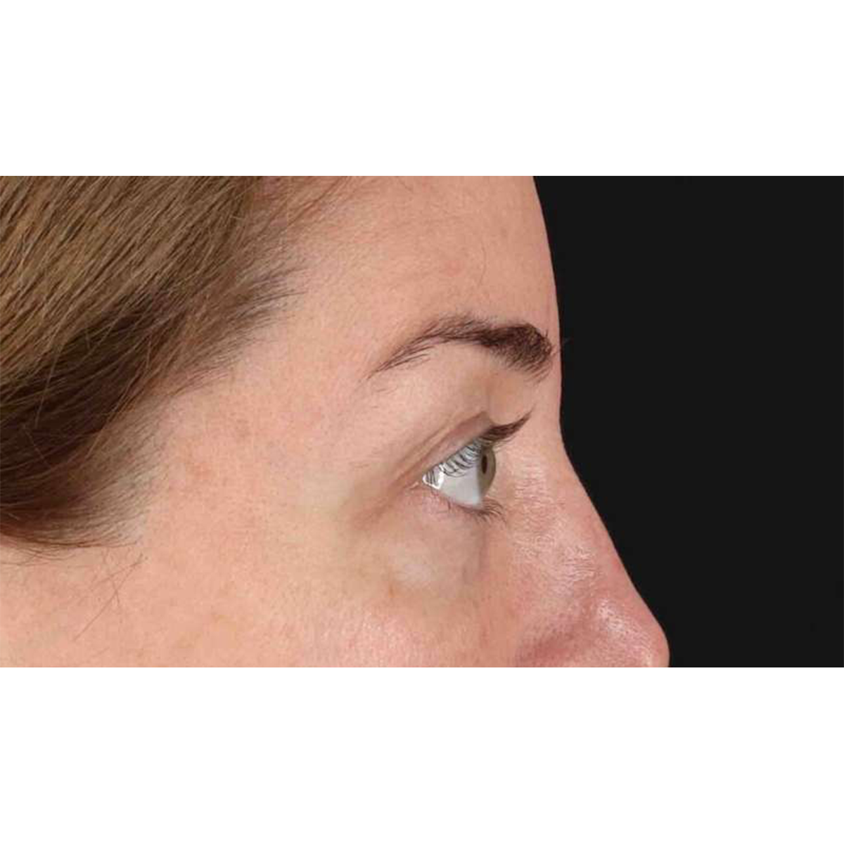 Blepharoplasty (Eyelid Surgery) Before & After Patient #10584