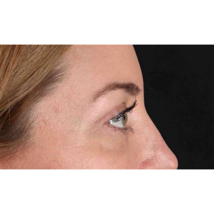 Blepharoplasty (Eyelid Surgery) Before & After Patient #10584