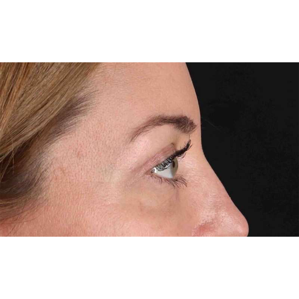 Blepharoplasty (Eyelid Surgery) Before & After Patient #10584