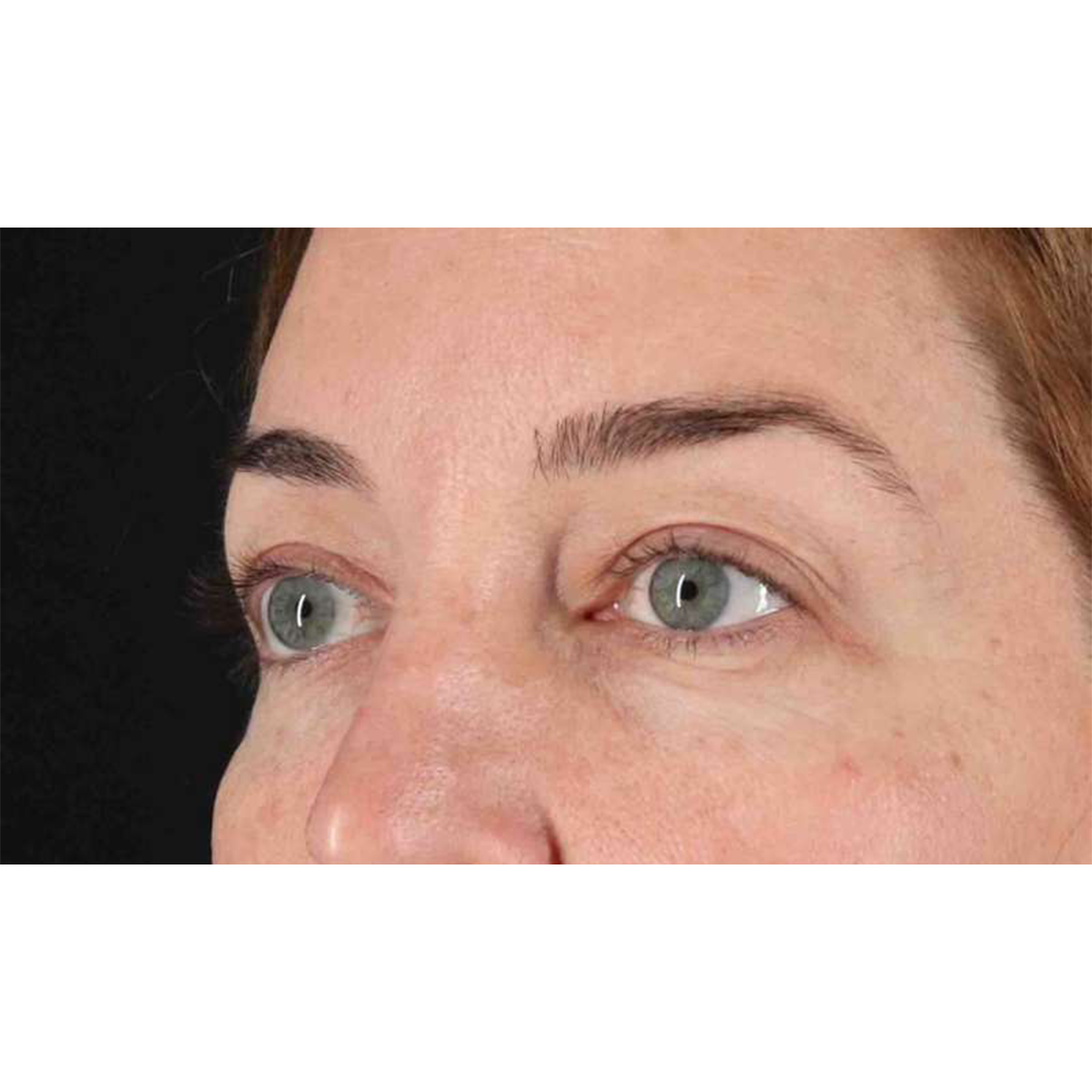Blepharoplasty (Eyelid Surgery) Before & After Patient #10584