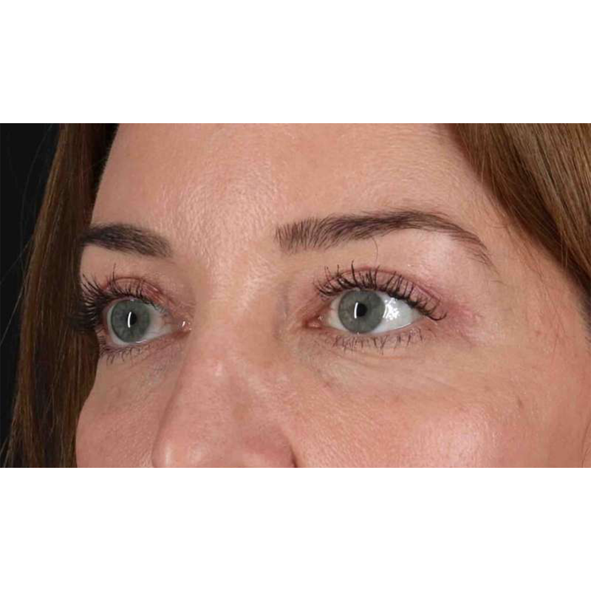 Blepharoplasty (Eyelid Surgery) Before & After Patient #10584