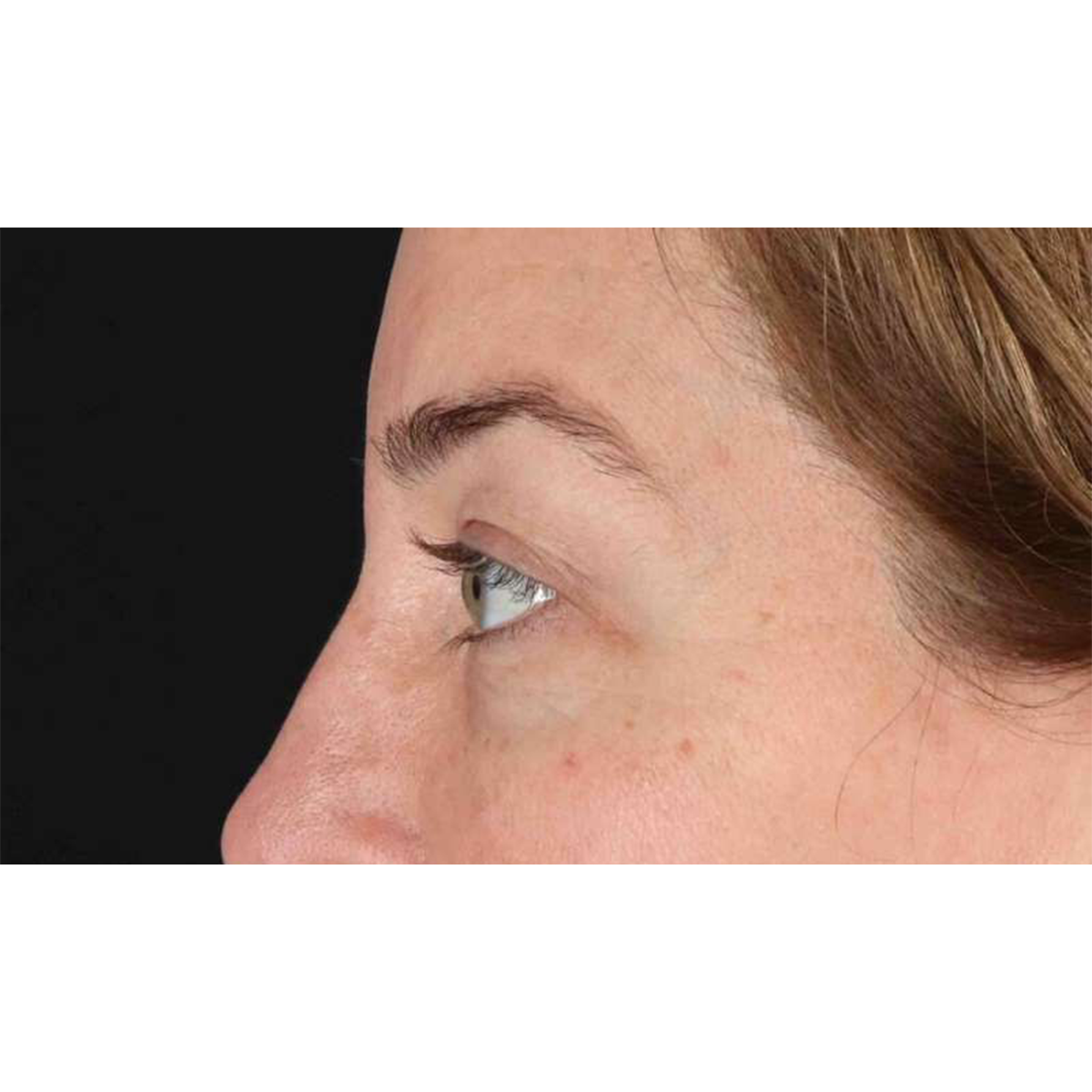 Blepharoplasty (Eyelid Surgery) Before & After Patient #10584