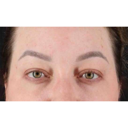 Blepharoplasty (Eyelid Surgery) Before & After Patient #10573