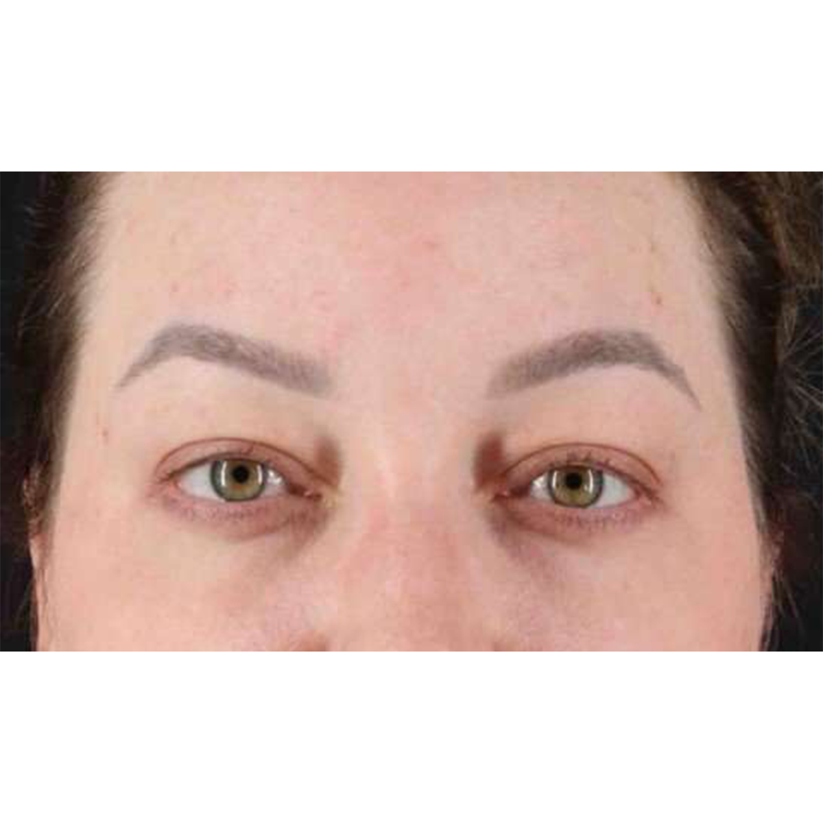 Blepharoplasty (Eyelid Surgery) Before & After Patient #10573