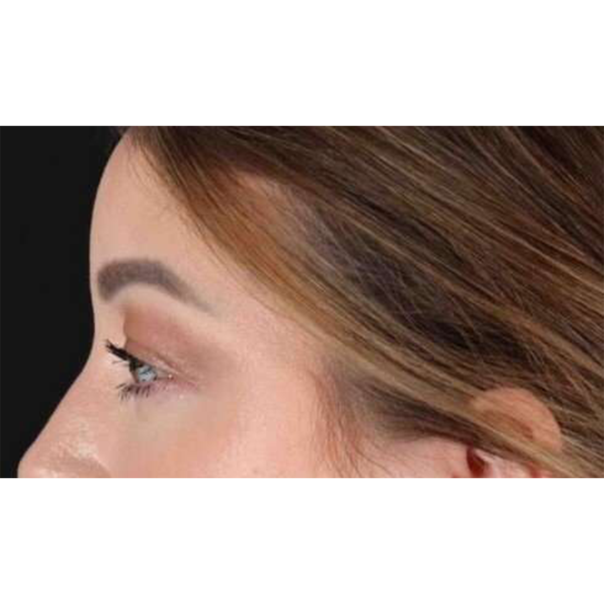 Blepharoplasty (Eyelid Surgery) Before & After Patient #10573