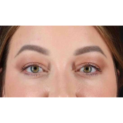 Blepharoplasty (Eyelid Surgery) Before & After Patient #10573
