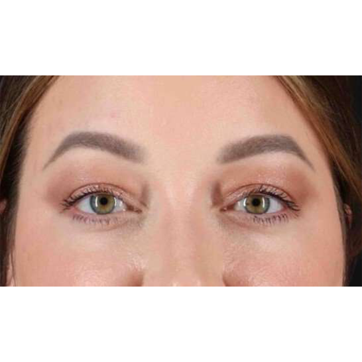 Blepharoplasty (Eyelid Surgery) Before & After Patient #10573