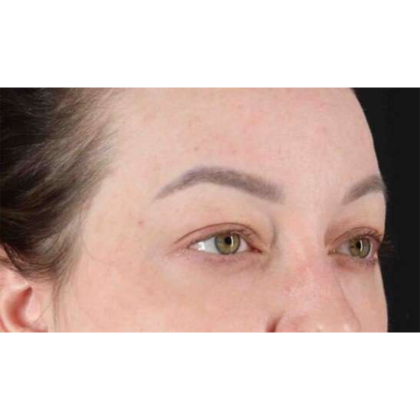 Blepharoplasty (Eyelid Surgery) Before & After Patient #10573