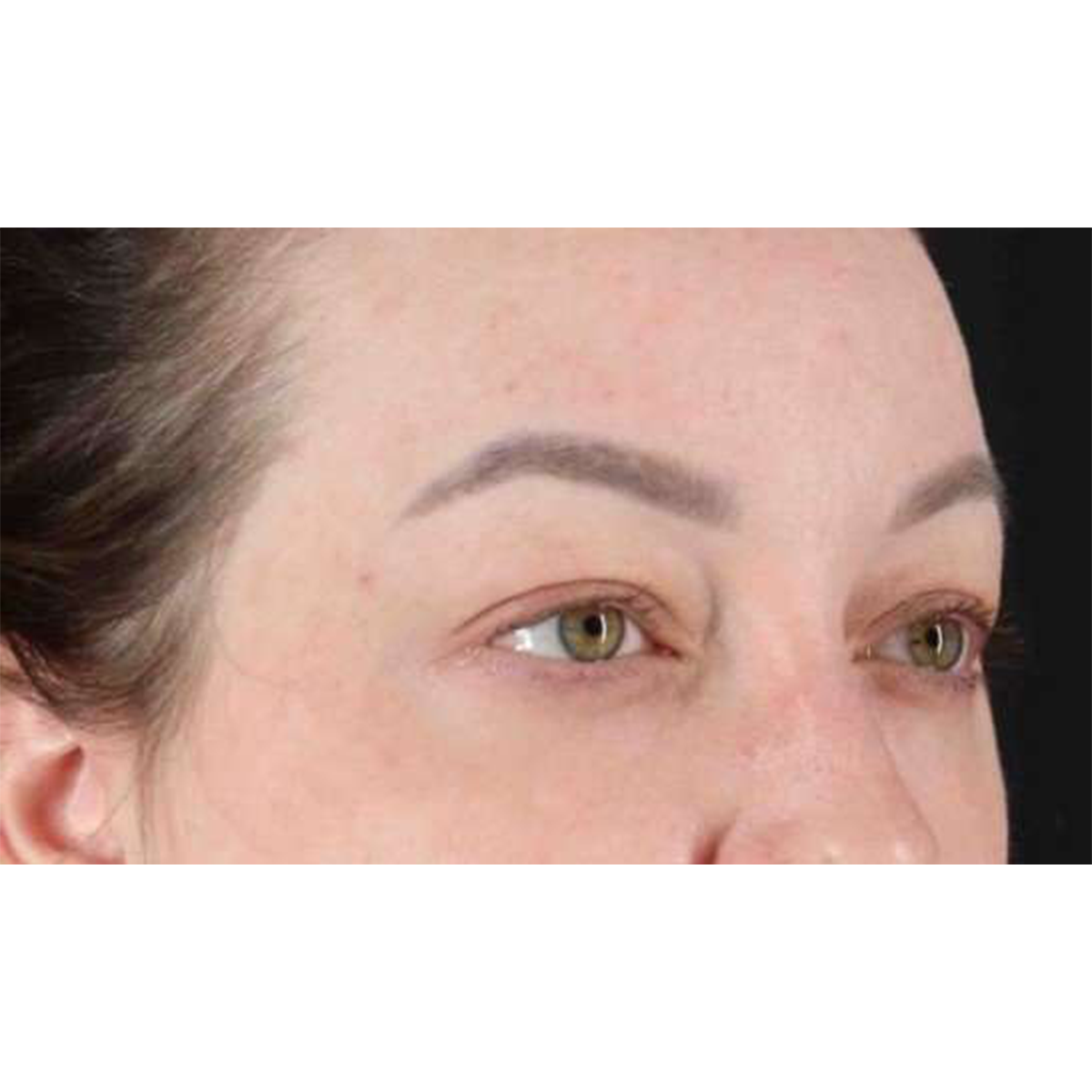 Blepharoplasty (Eyelid Surgery) Before & After Patient #10573