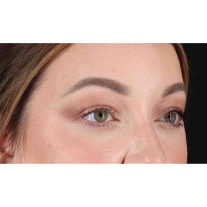 Blepharoplasty (Eyelid Surgery) Before & After Patient #10573