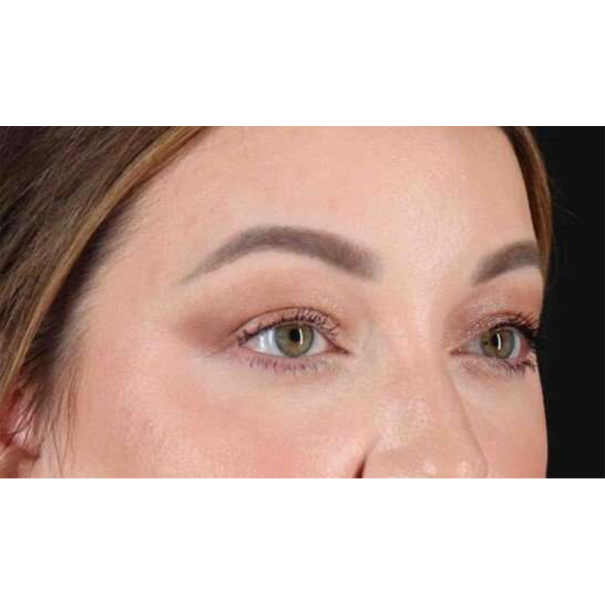 Blepharoplasty (Eyelid Surgery) Before & After Patient #10573