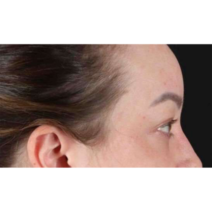 Blepharoplasty (Eyelid Surgery) Before & After Patient #10573