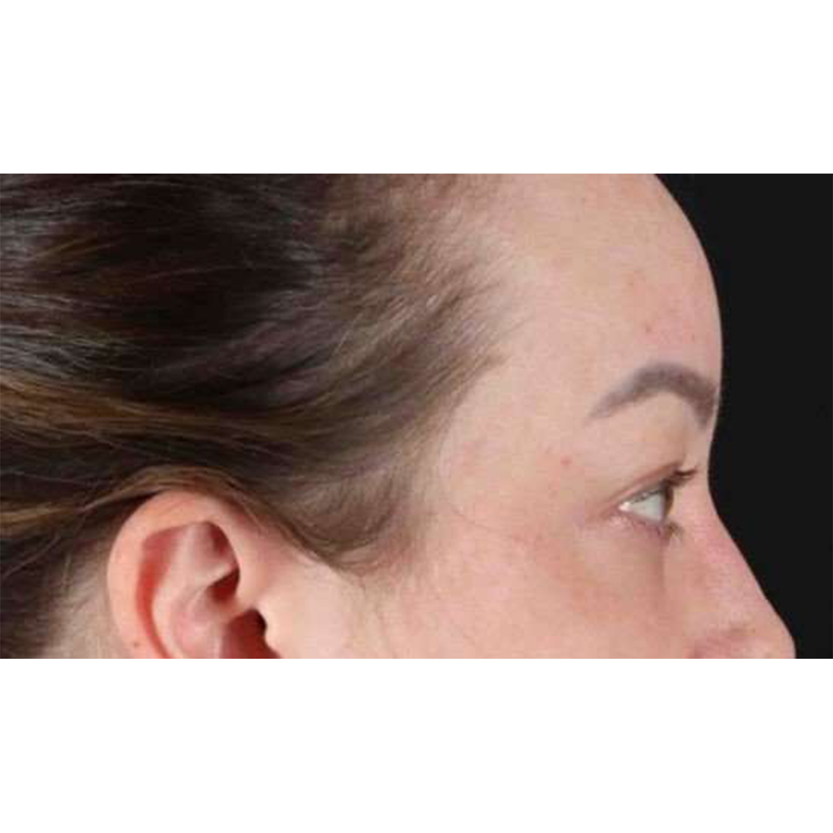 Blepharoplasty (Eyelid Surgery) Before & After Patient #10573