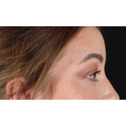 Blepharoplasty (Eyelid Surgery) Before & After Patient #10573