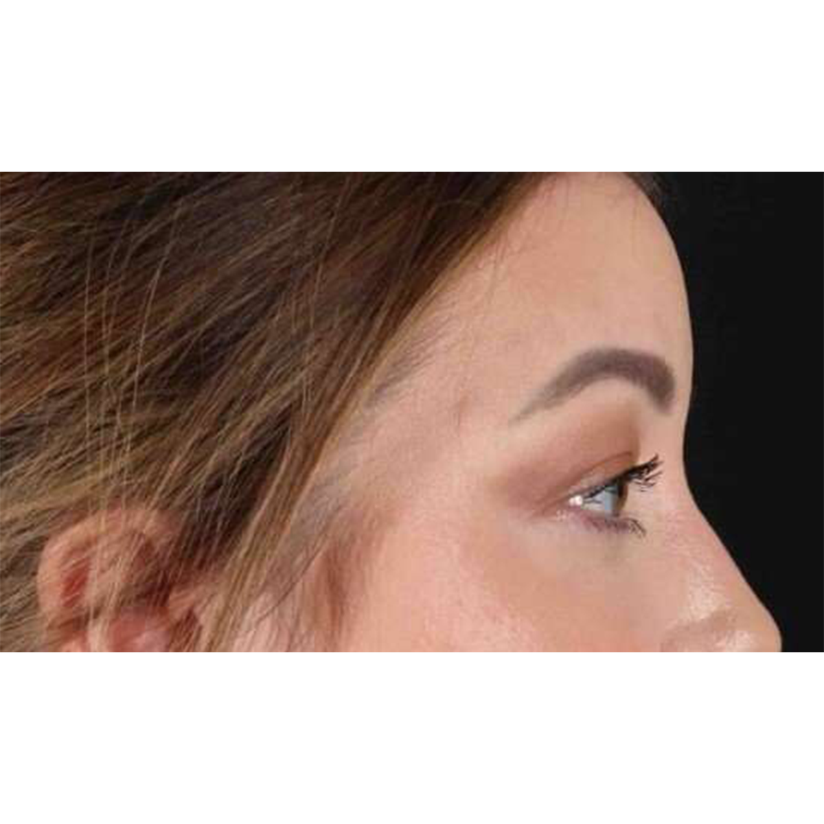 Blepharoplasty (Eyelid Surgery) Before & After Patient #10573