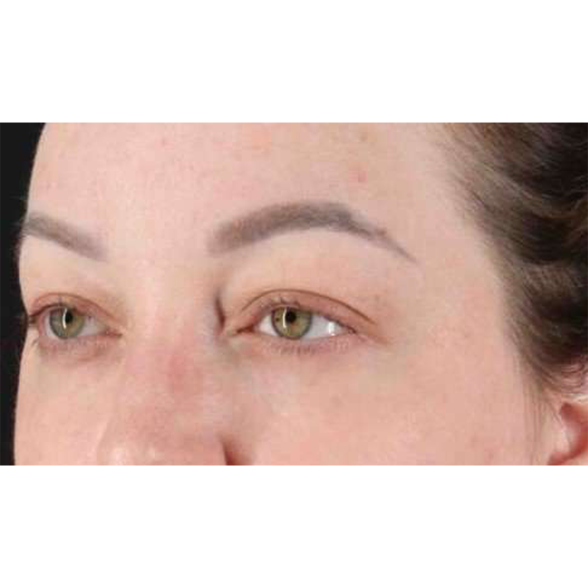 Blepharoplasty (Eyelid Surgery) Before & After Patient #10573