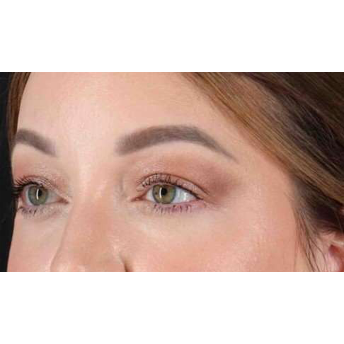 Blepharoplasty (Eyelid Surgery) Before & After Patient #10573