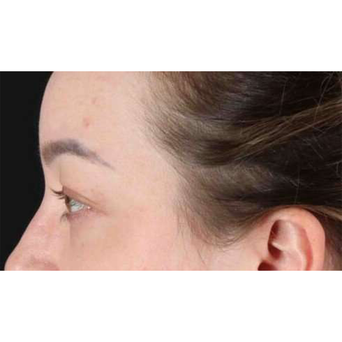 Blepharoplasty (Eyelid Surgery) Before & After Patient #10573