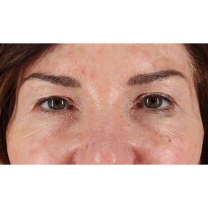 Blepharoplasty (Eyelid Surgery) Before & After Patient #10562