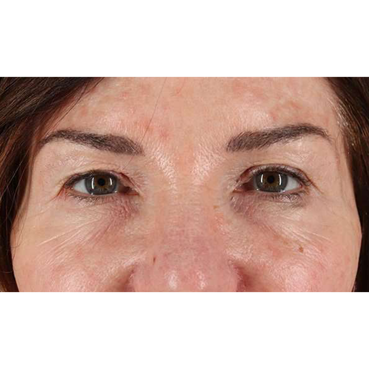 Blepharoplasty (Eyelid Surgery) Before & After Patient #10562