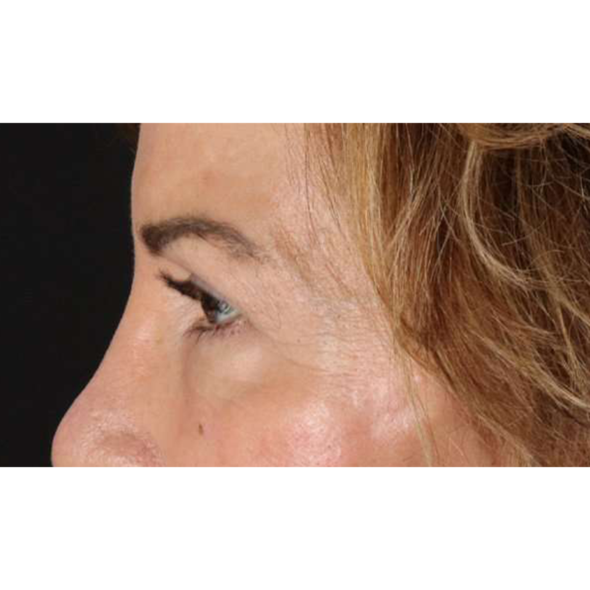Blepharoplasty (Eyelid Surgery) Before & After Patient #10562