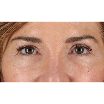 Blepharoplasty (Eyelid Surgery) Before & After Patient #10562