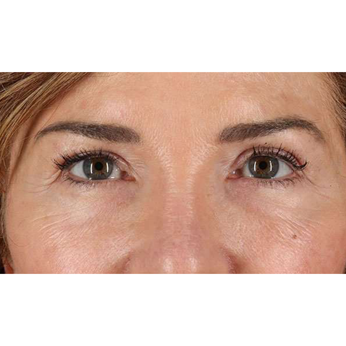 Blepharoplasty (Eyelid Surgery) Before & After Patient #10562