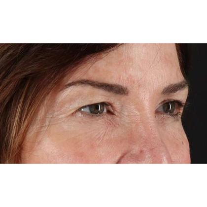 Blepharoplasty (Eyelid Surgery) Before & After Patient #10562