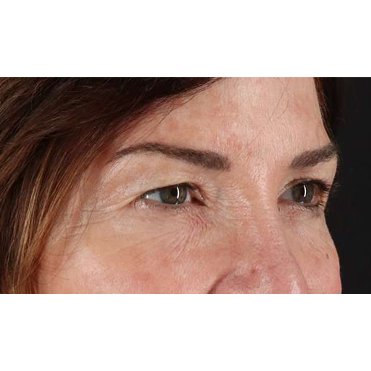 Blepharoplasty (Eyelid Surgery) Before & After Patient #10562