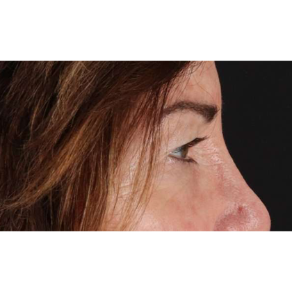 Blepharoplasty (Eyelid Surgery) Before & After Patient #10562