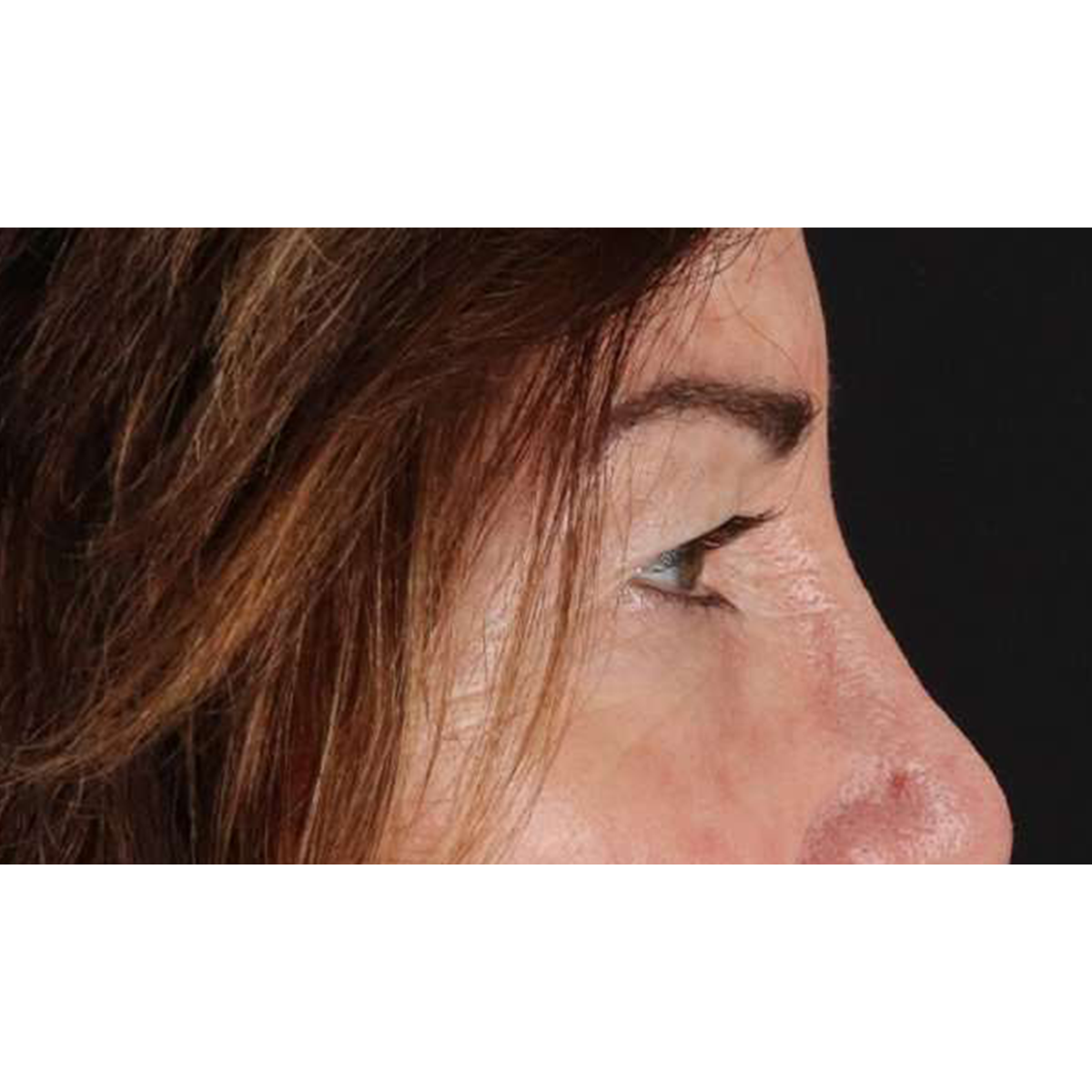 Blepharoplasty (Eyelid Surgery) Before & After Patient #10562