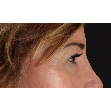 Blepharoplasty (Eyelid Surgery) Before & After Patient #10562