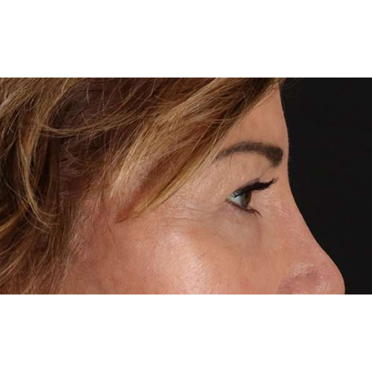 Blepharoplasty (Eyelid Surgery) Before & After Patient #10562