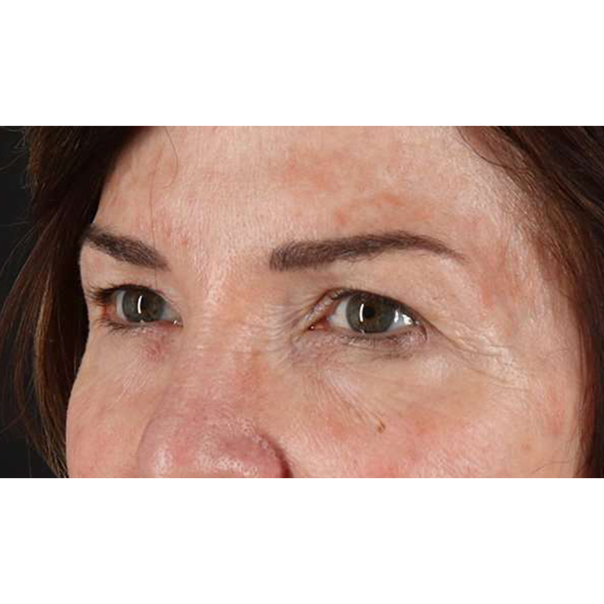 Blepharoplasty (Eyelid Surgery) Before & After Patient #10562