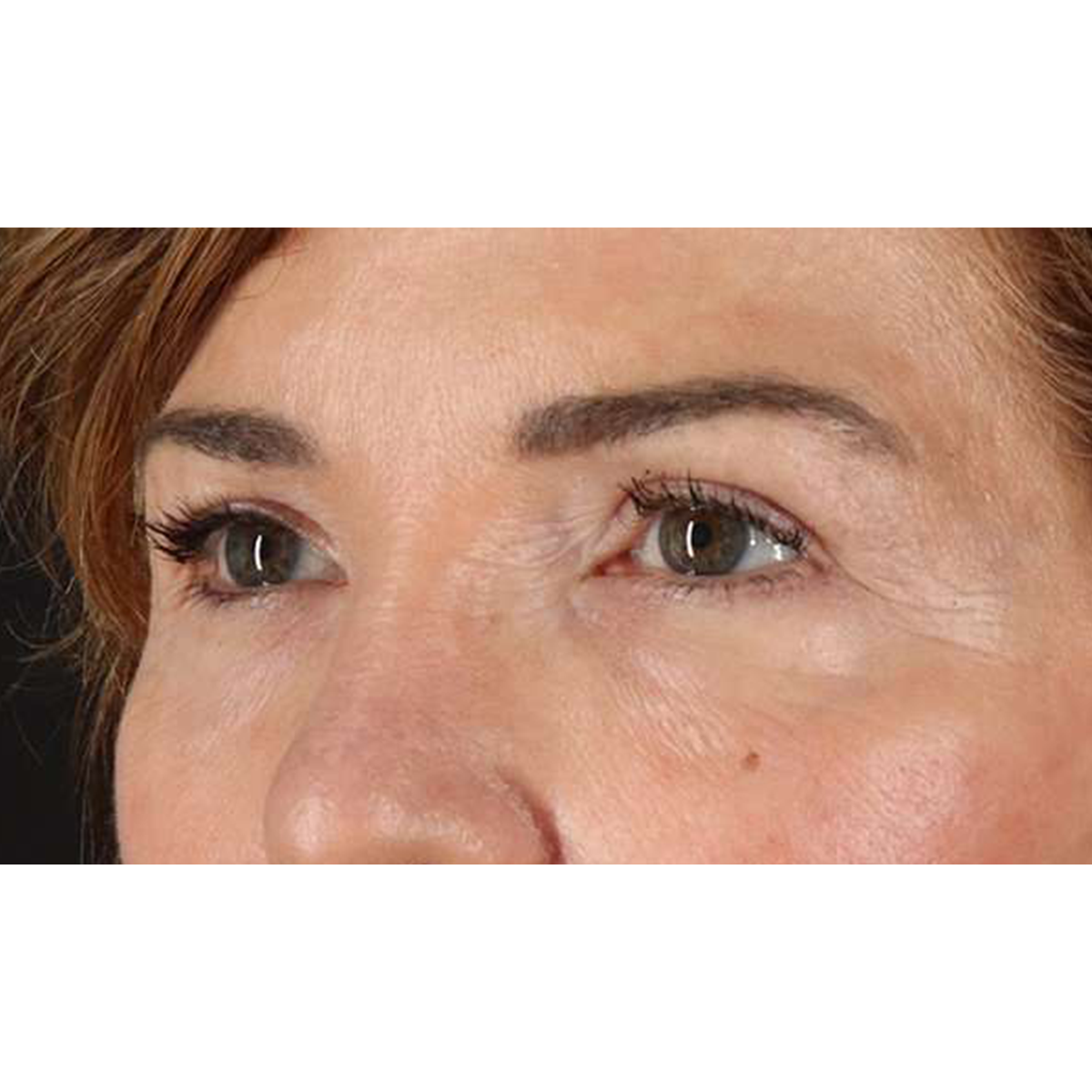 Blepharoplasty (Eyelid Surgery) Before & After Patient #10562