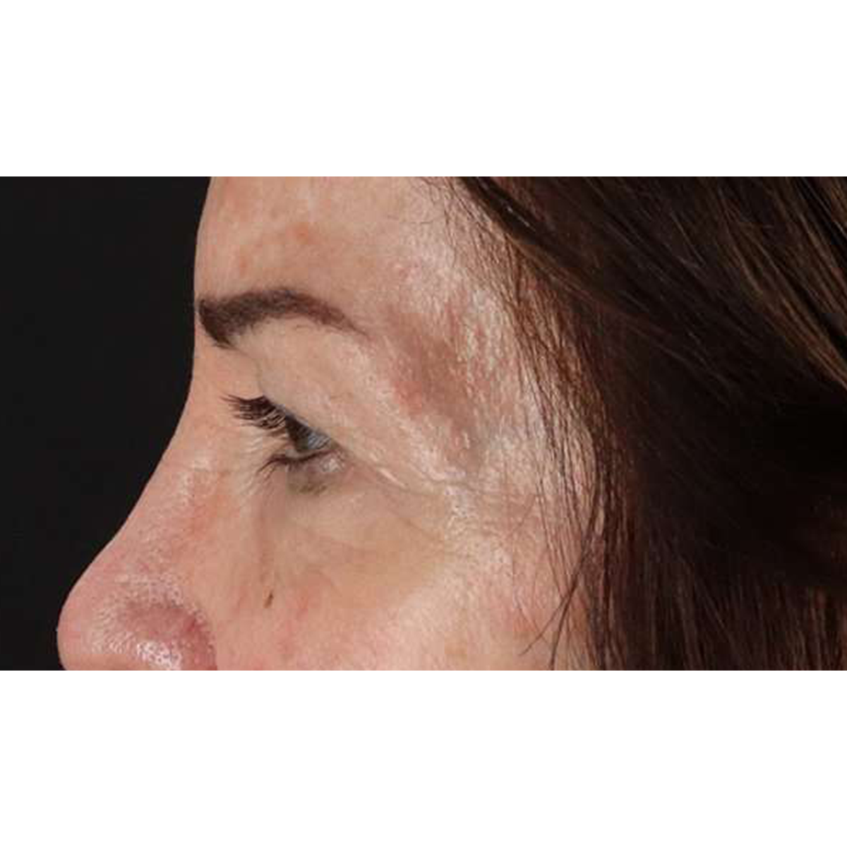 Blepharoplasty (Eyelid Surgery) Before & After Patient #10562