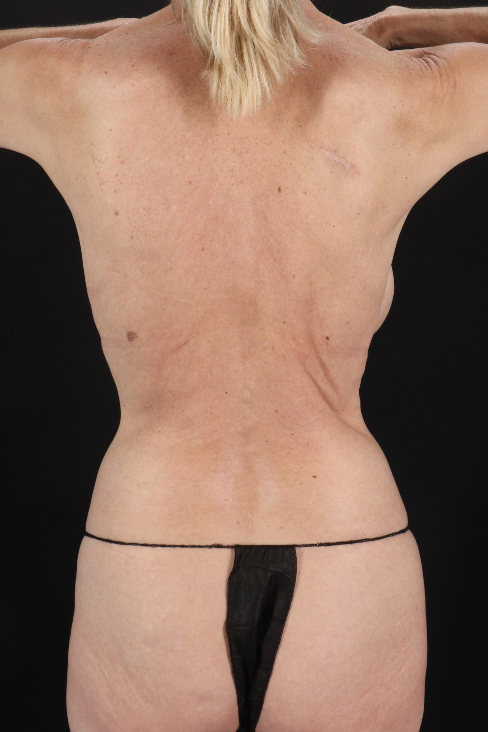 All Me Augmentation Before & After Patient #10282