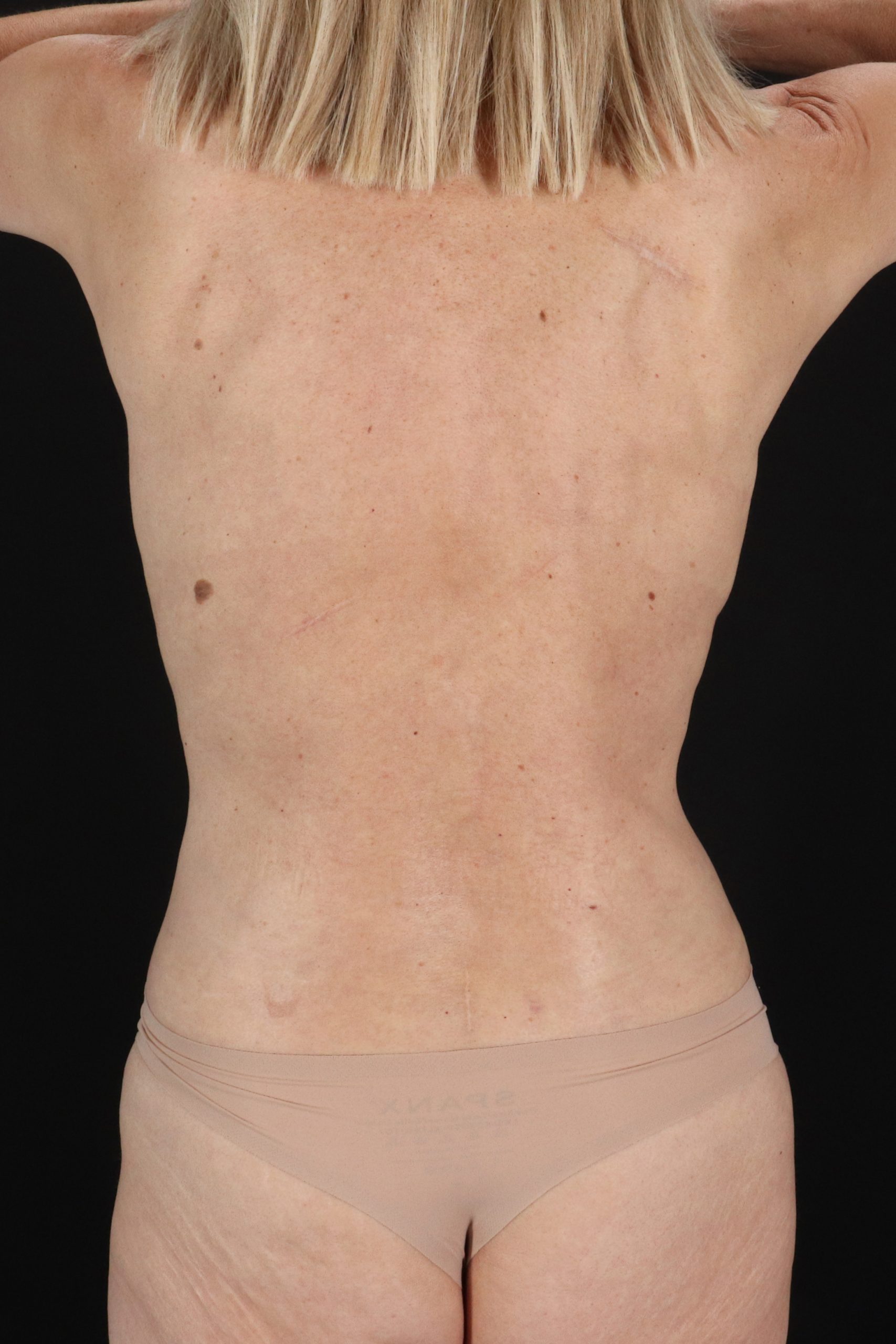 All Me Augmentation Before & After Patient #10282