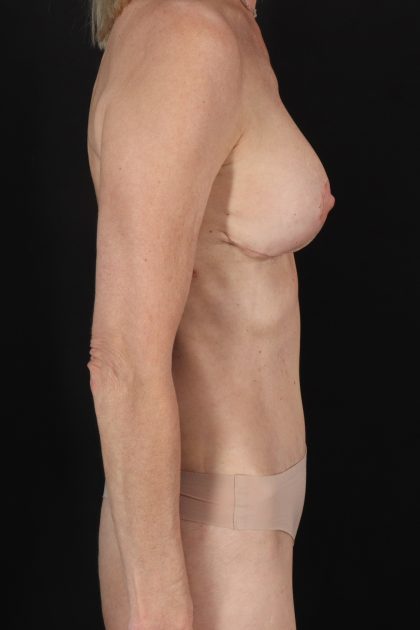 All Me Augmentation Before & After Patient #10282