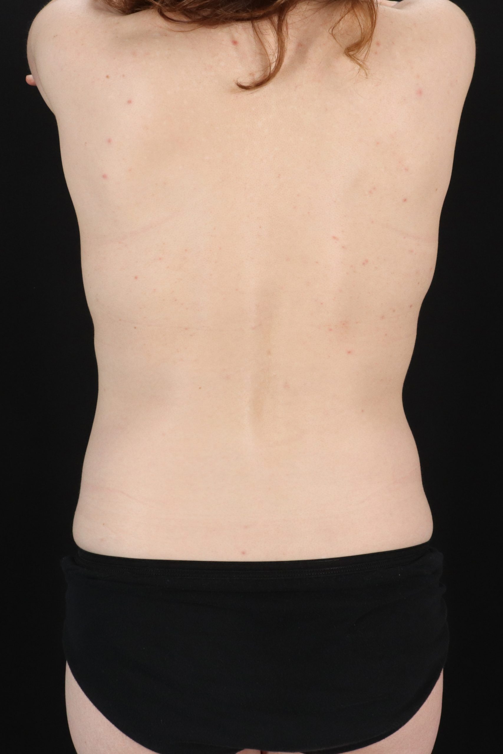 All Me Augmentation Before & After Patient #10283