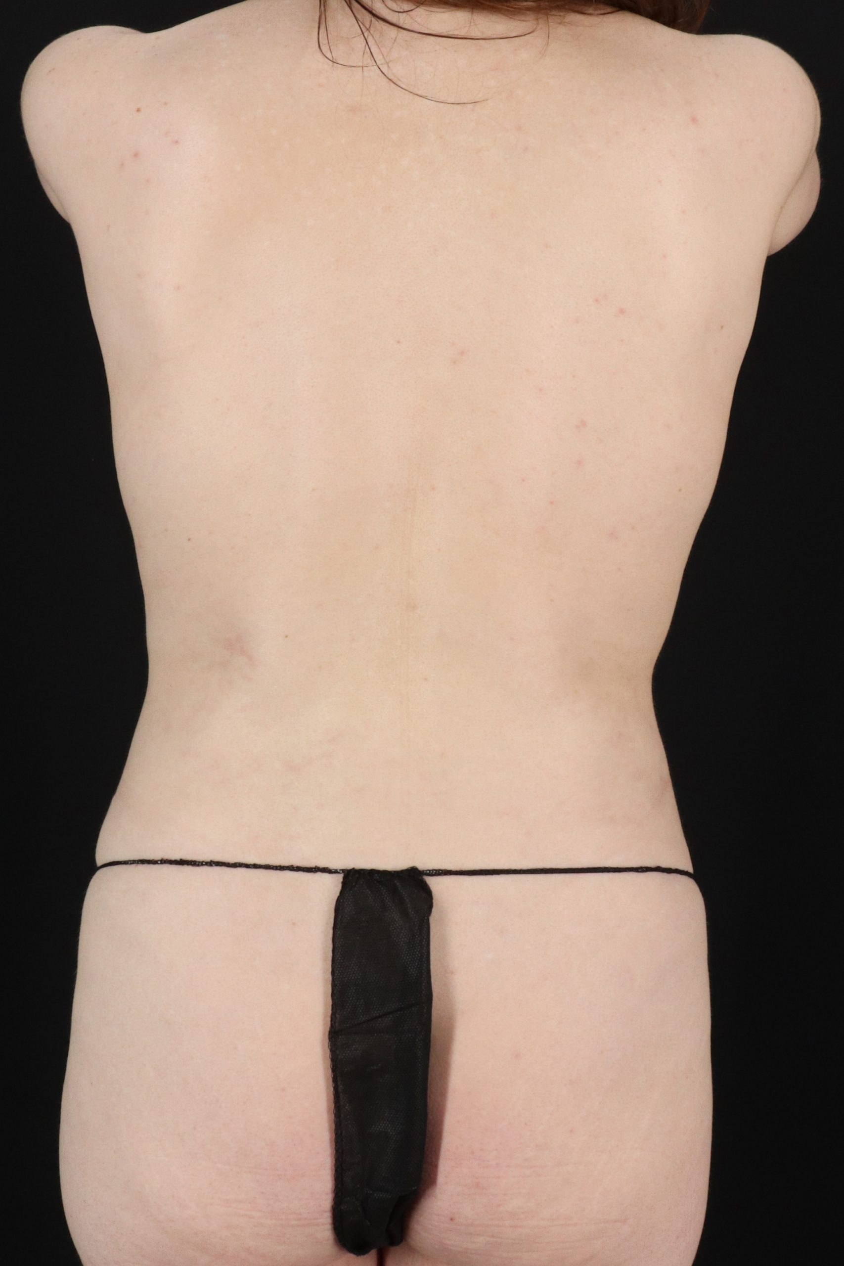 All Me Augmentation Before & After Patient #10283