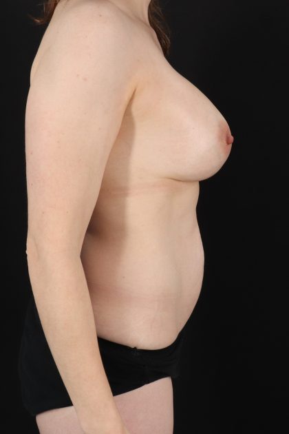 All Me Augmentation Before & After Patient #10283