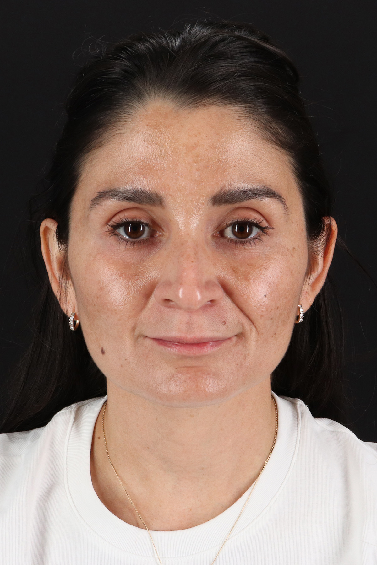 CO2 Laser Before & After Patient #10936