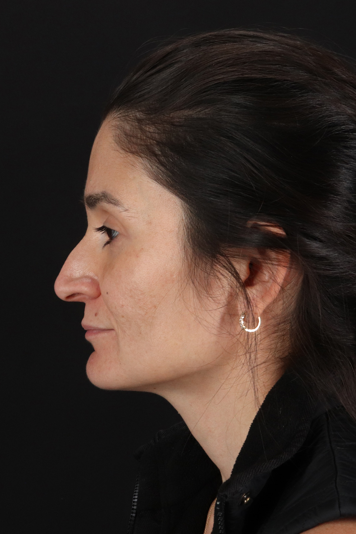 CO2 Laser Before & After Patient #10936