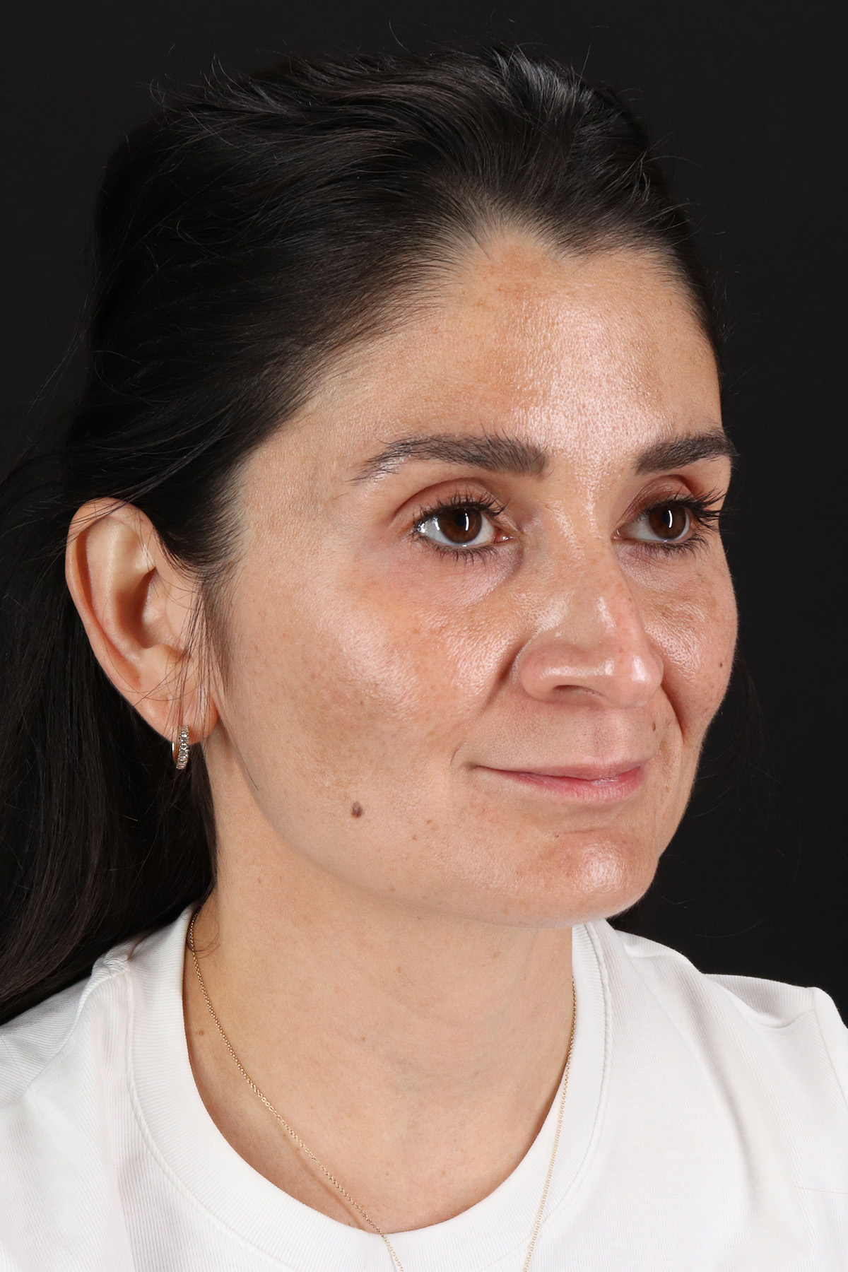 CO2 Laser Before & After Patient #10936