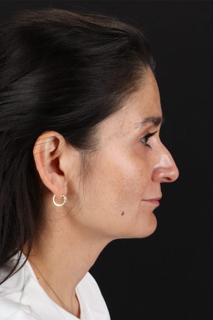 CO2 Laser Before & After Patient #10936