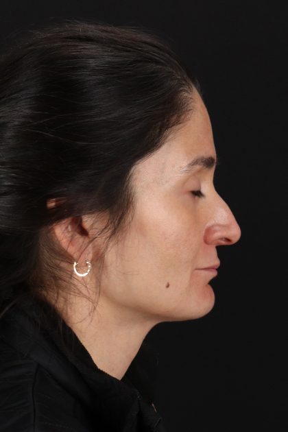 CO2 Laser Before & After Patient #10936