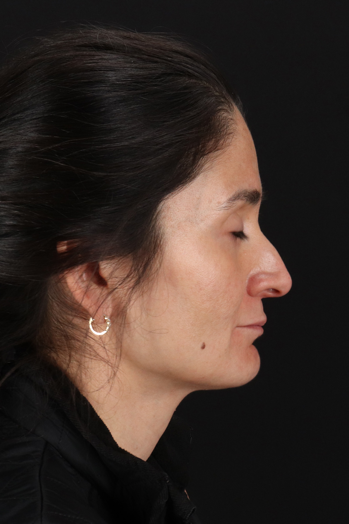 CO2 Laser Before & After Patient #10936