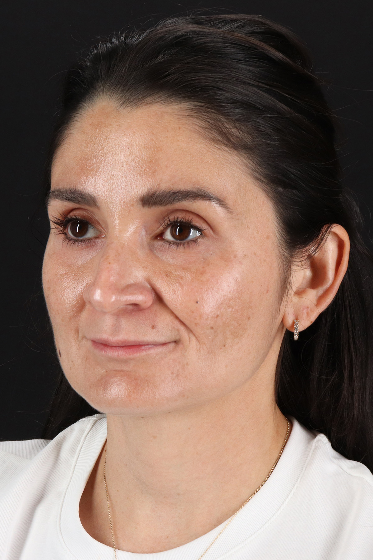 CO2 Laser Before & After Patient #10936